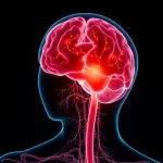 Stroke risk increases with this blood type even in youth
